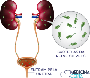 Tudo Sobre Infec O Urin Ria Sintomas Diagnostico Medicinacerta