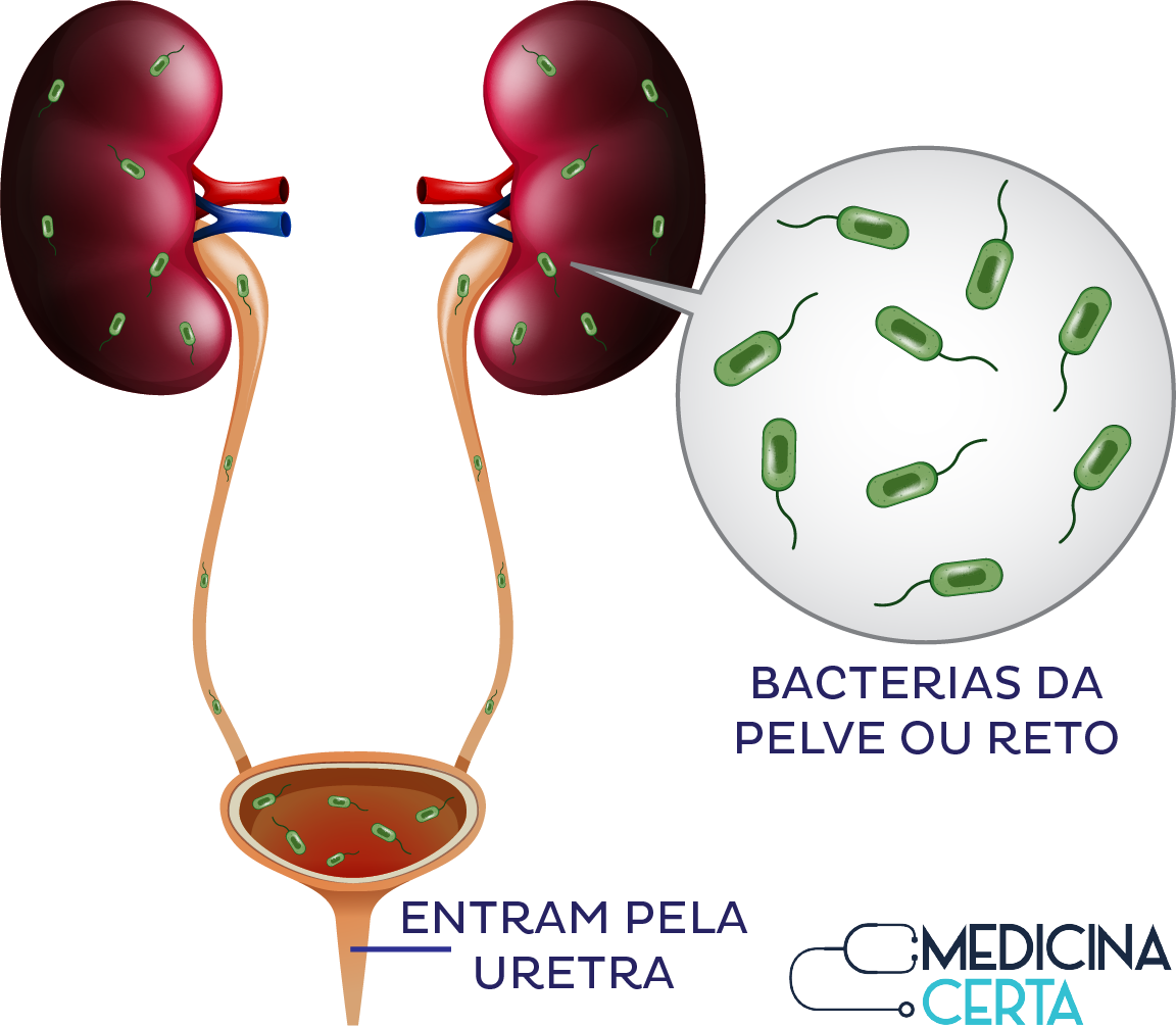Como se pega infecção de urina