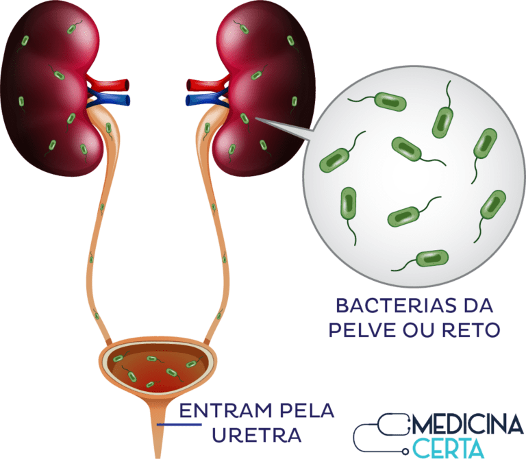 Tudo sobre Infecção Urinária - Sintomas -Diagnostico - MedicinaCerta